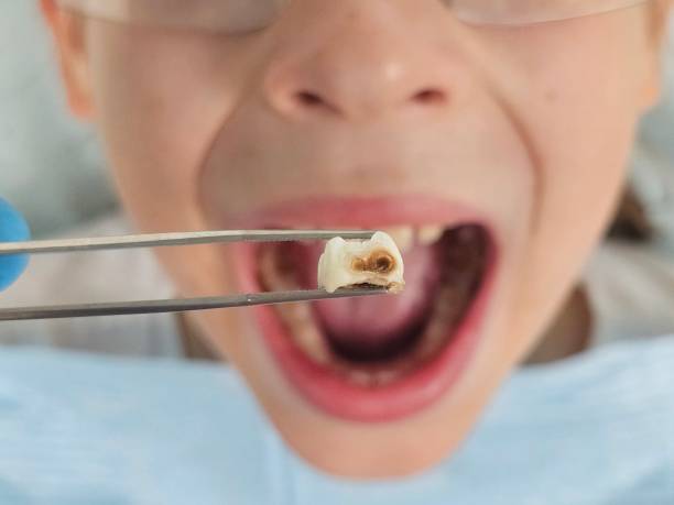 Best Emergency Treatment for Dental Infections or Abscesses in Ina, IL
